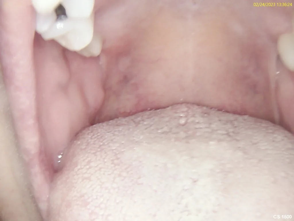 Clinical photograph of the soft palate and airway before NightLase treatment began