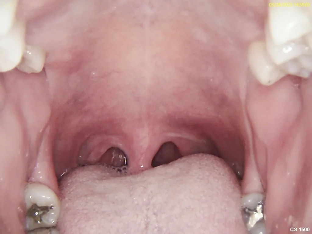 Clinical photograph of the soft palate and airway partway through the NightLase treatment series