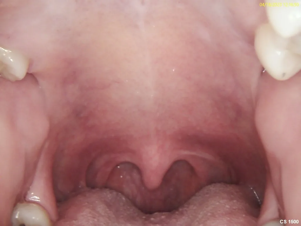 Clinical photograph of the soft palate and airway after the NightLase treatment series was completed