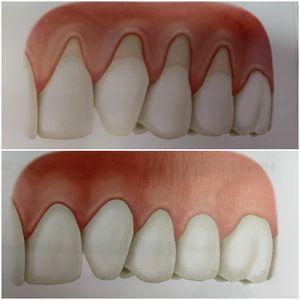 Dental illustration used for gum grafting care
